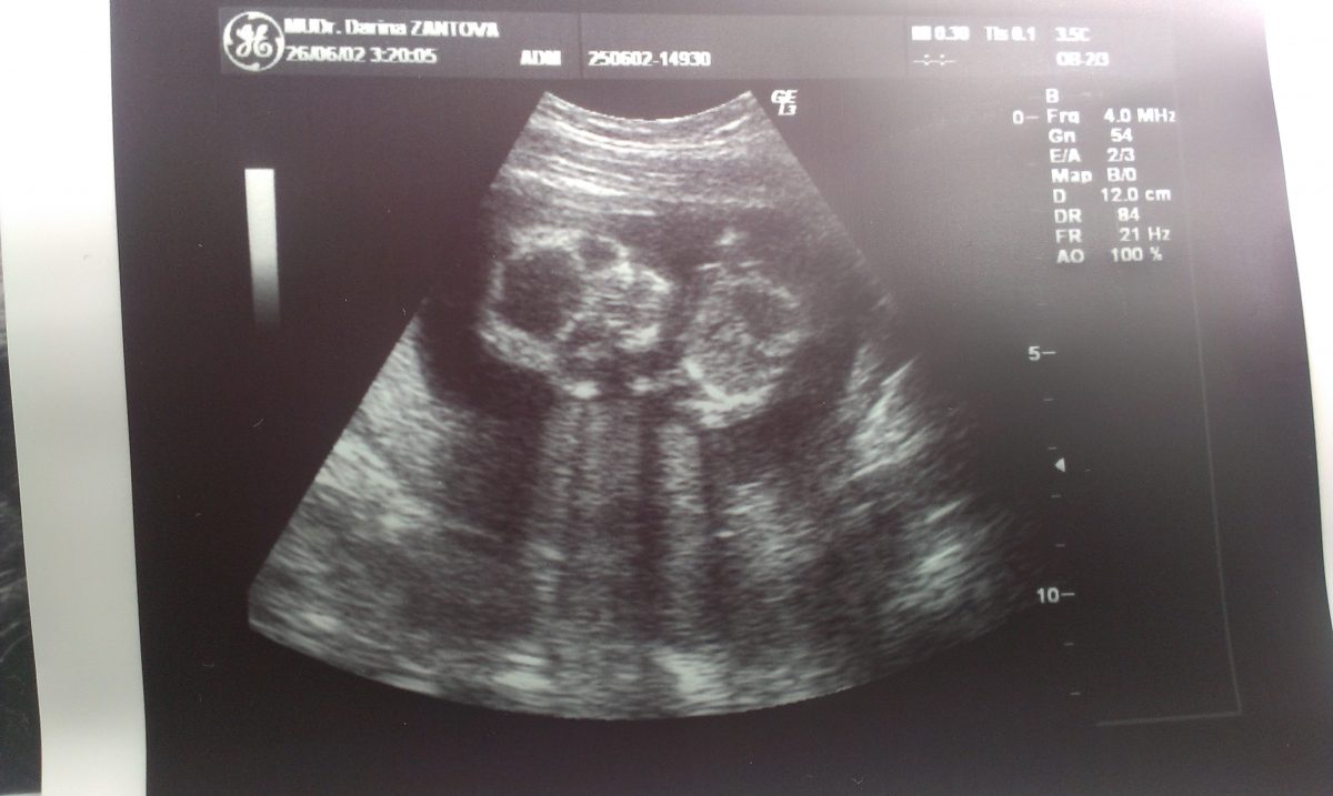 Fotografie (Je to potvrzeno – bude to chlapeček :))