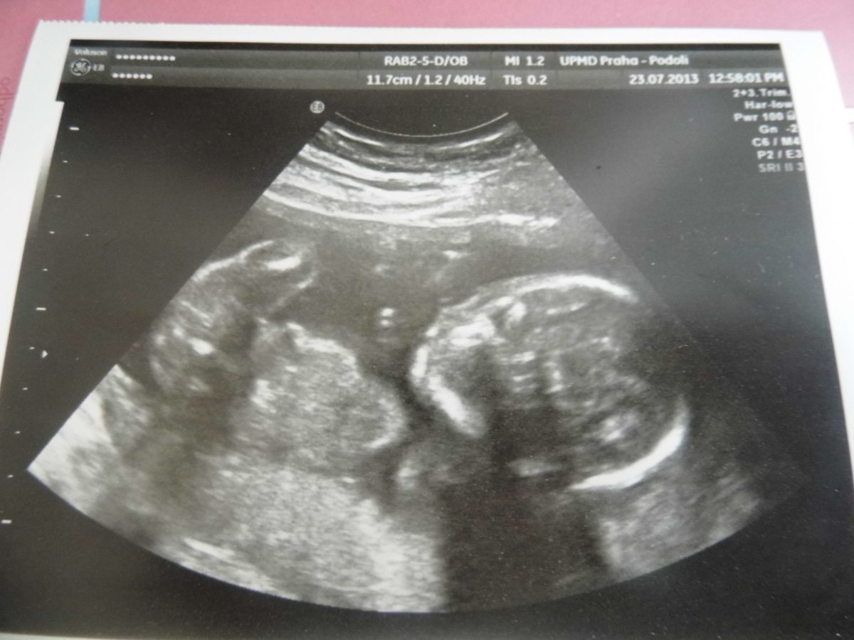Fotografie (Těhotenství s RS: Vše není jen zlé)