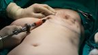 prso-rekontrukce-operace-plasticka_chirurgie-plastika-istock_000023908641small-144x81.jpg